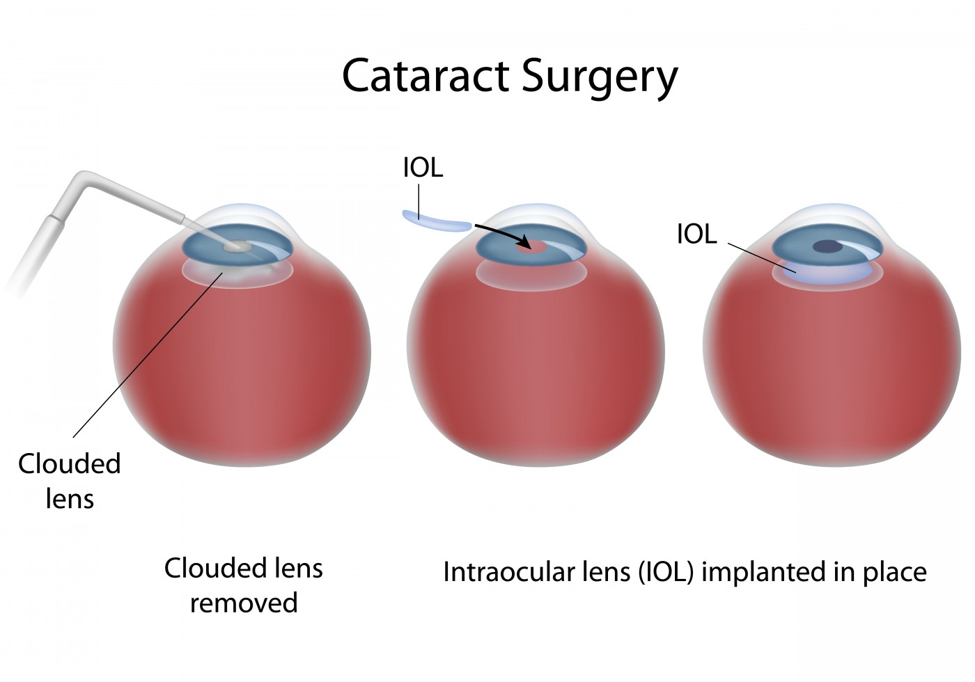 Researchers to Study Effect of Cataract Surgery on Circadian Rhythm Disorders