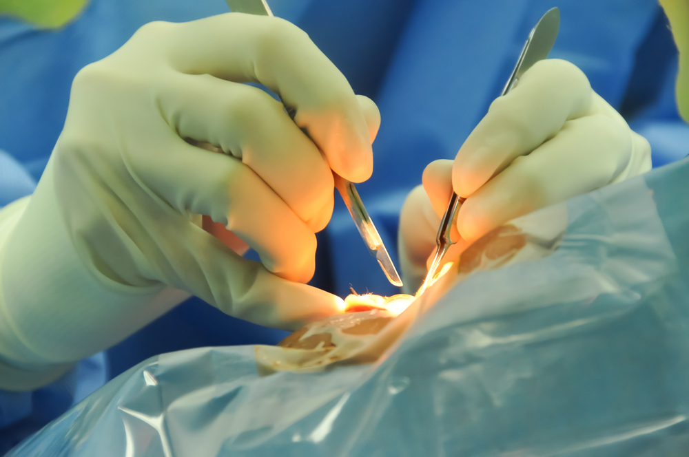 Residual Astigmatism May Require Surgical Correction After Cataract Surgery